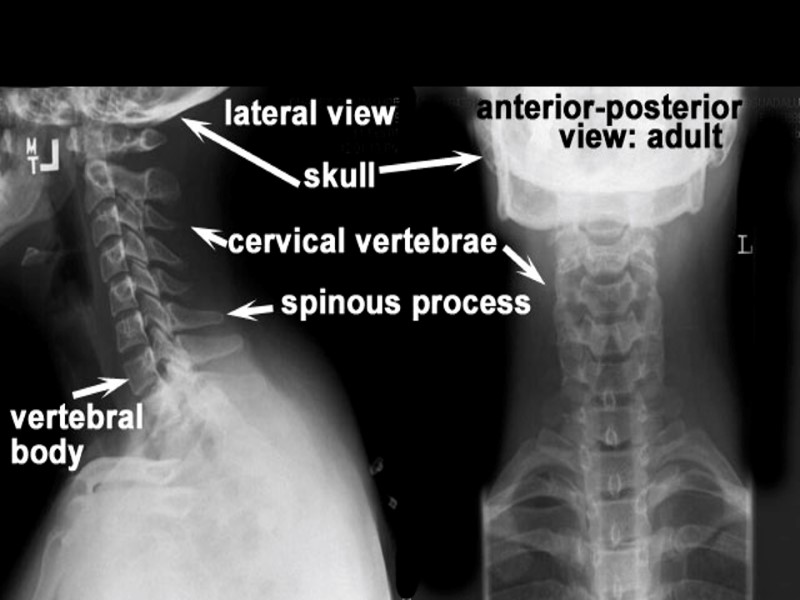 Normal Cervical Spine